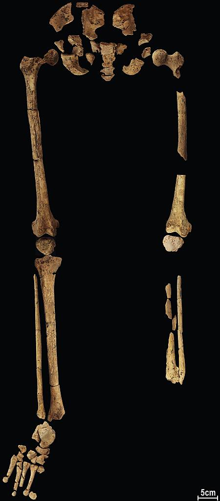 esqueleto con la parte inferior del hueso de la pierna amputada