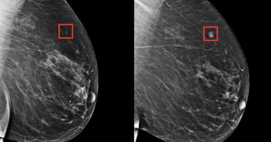 Inteligencia artificial es capaz de detectar tempranamente cáncer de mama 5 años antes de su desarrollo