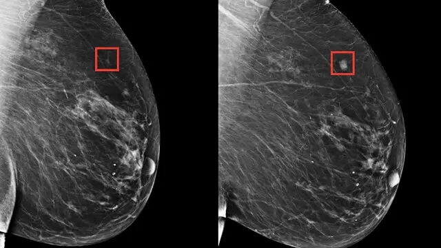 Inteligencia artificial es capaz de detectar tempranamente cáncer de mama 5 años antes de su desarrollo
