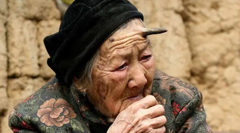 La historia de la anciana china a quien le comenzó a crecer un cuerno negro en la frente